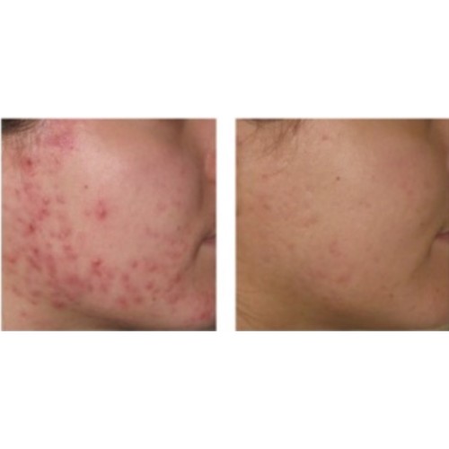 ANP Skin Accumax 袪痘淨滑療程 60粒 ANP Skin Accumax 袪痘淨滑療程 60粒